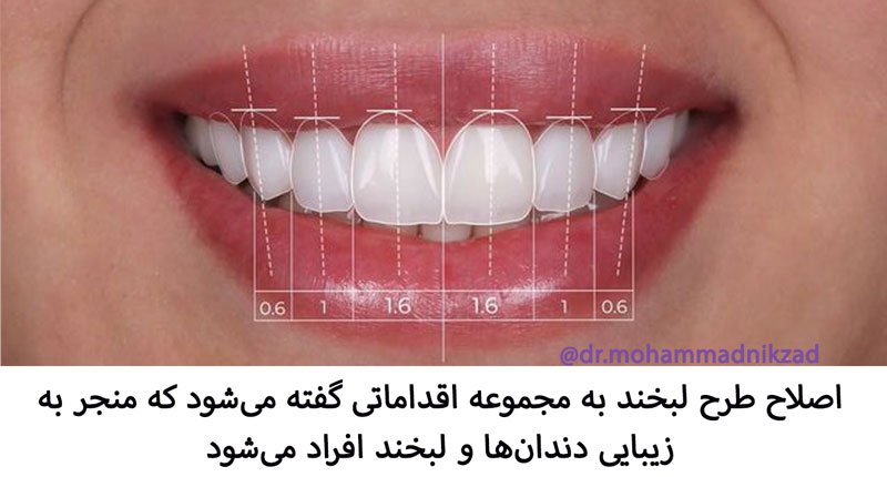 اصلاح طرح لبخند به مجموعه اقداماتی گفته می شود که منجر به زیبایی دندان ها و لبخد افراد می شود